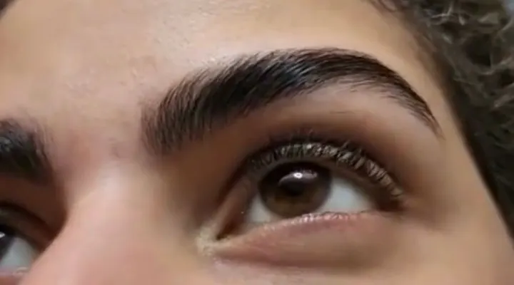 Sourcils après un brow lift